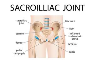 ilustração de inflamação sacral do quadril dolorosa, bursite de dor no quadril, artrite. vetor