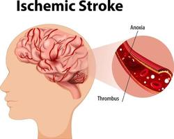 humano com acidente vascular cerebral isquêmico vetor