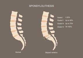 ilustração vetorial da coluna lombar e espondilolite vetor