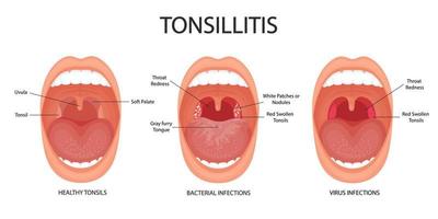 angina, faringite e amigdalite. amigdalite bacteriana e viral. infecção da amígdala. boca aberta, anatomia. vetor