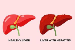 fígado humano saudável e fígado humano com hepatite vetor