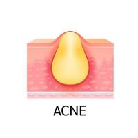 formação de acne ou espinha na pele. anatomia da pele. conceito de cuidados com a pele de beleza médica. em um fundo branco. vetor 3D.