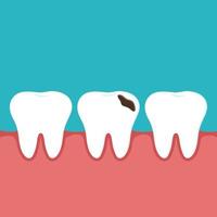 ilustração médica odontológica vetorial de um dente saudável e um dente com cárie e um buraco na gengiva. vetor