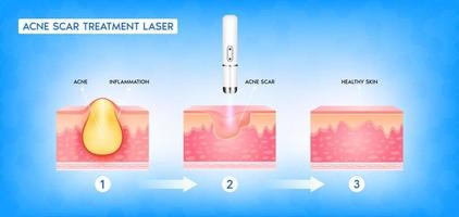 tratamento a laser vascular de cicatriz de acne. inflamação associada a espinhas. a estrutura da cicatriz da acne da pele. conceito de cuidados com a pele de beleza médica. ilustração em vetor 3D.