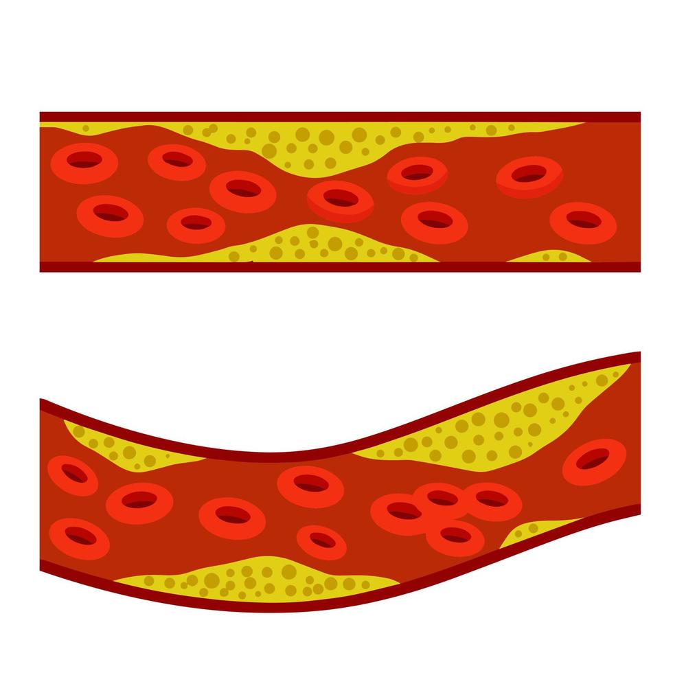 colesterolo nel sangue. vene e arterie con grasso. vettore