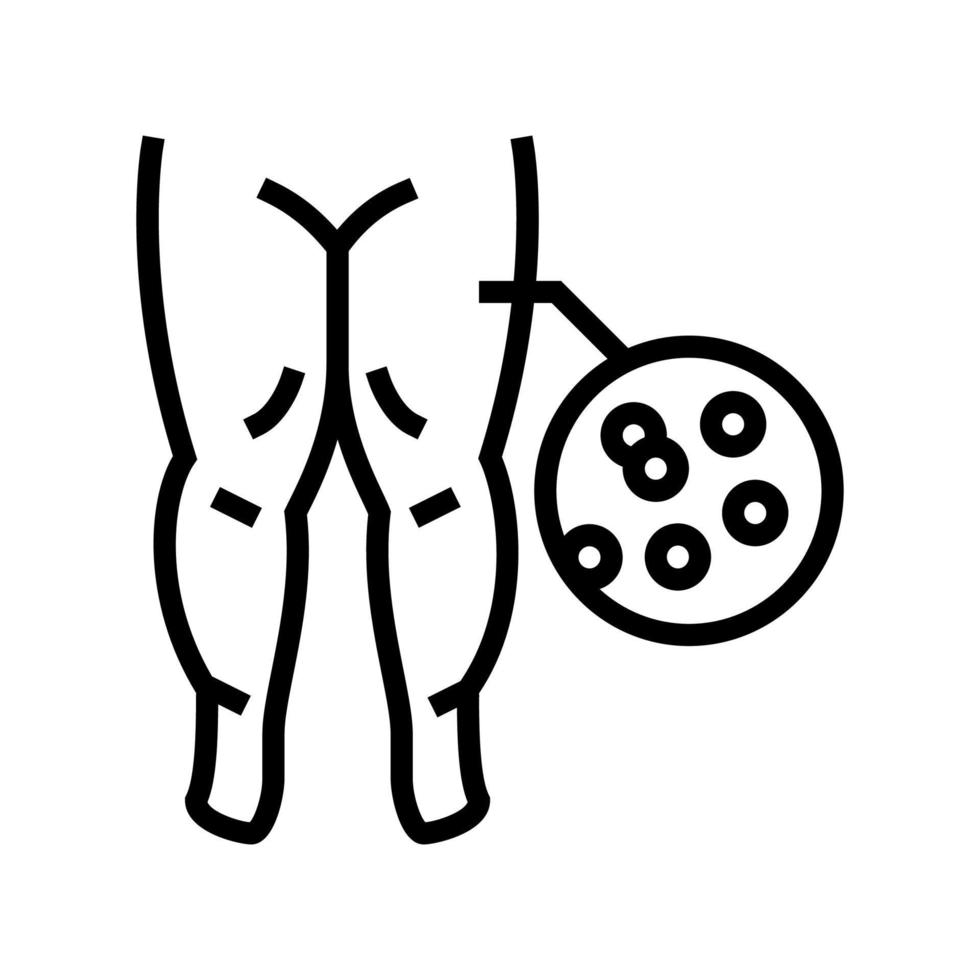 illustrazione vettoriale dell'icona della linea dell'edema ipoproteinemico