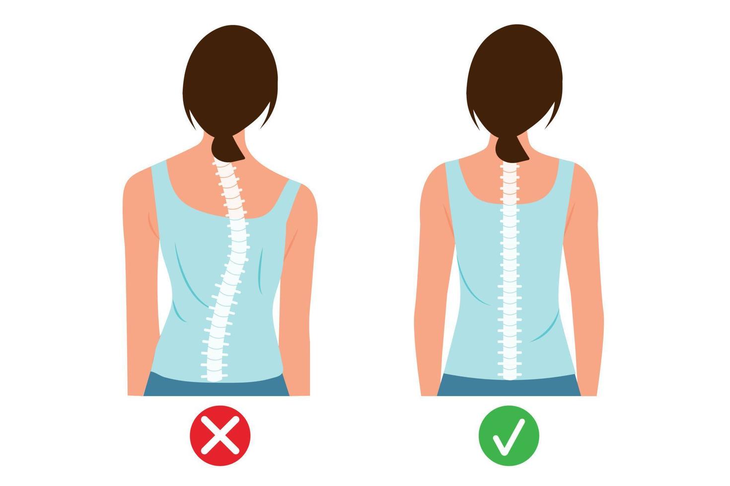 corpo della donna e backbone.infografica illustrazione della donna vista posteriore che rappresenta la scoliosi della colonna corretta e l'illustrazione vettoriale della scala di curvatura.