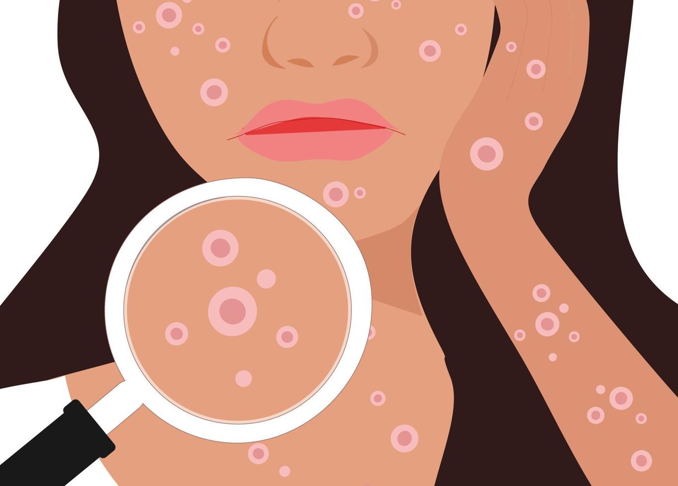 concetto di virus del vaiolo delle scimmie, donna che soffre di eruzioni cutanee su tutto il corpo. nuova illustrazione vettoriale di diffusione della pandemia di focolaio di virus orthopox