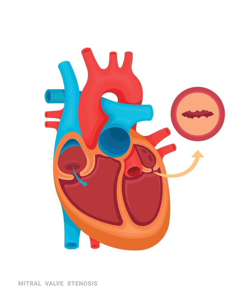 cuore di difetto vettore