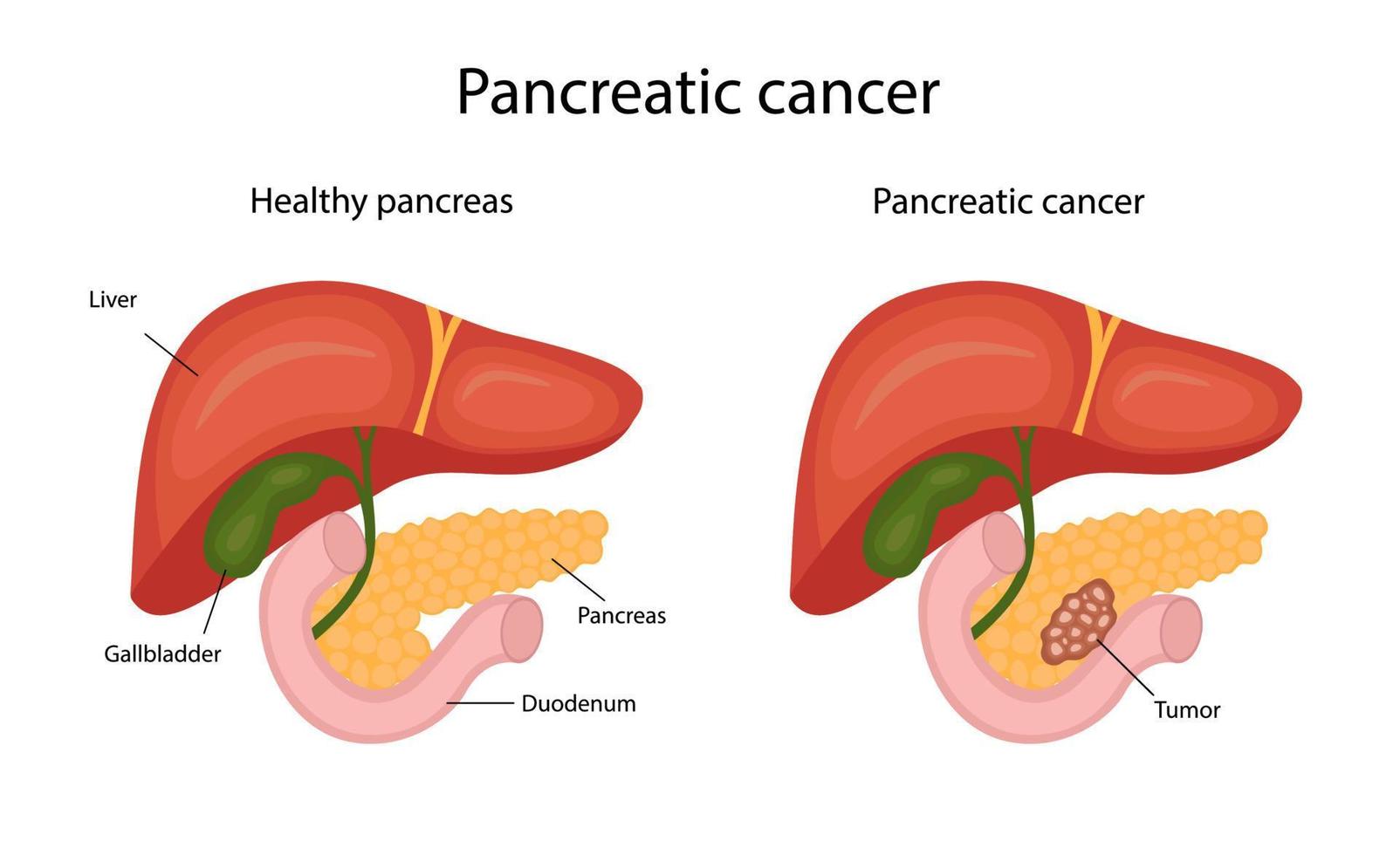 pancreatico cancro. infografica. vettore illustrazione nel cartone animato stile.