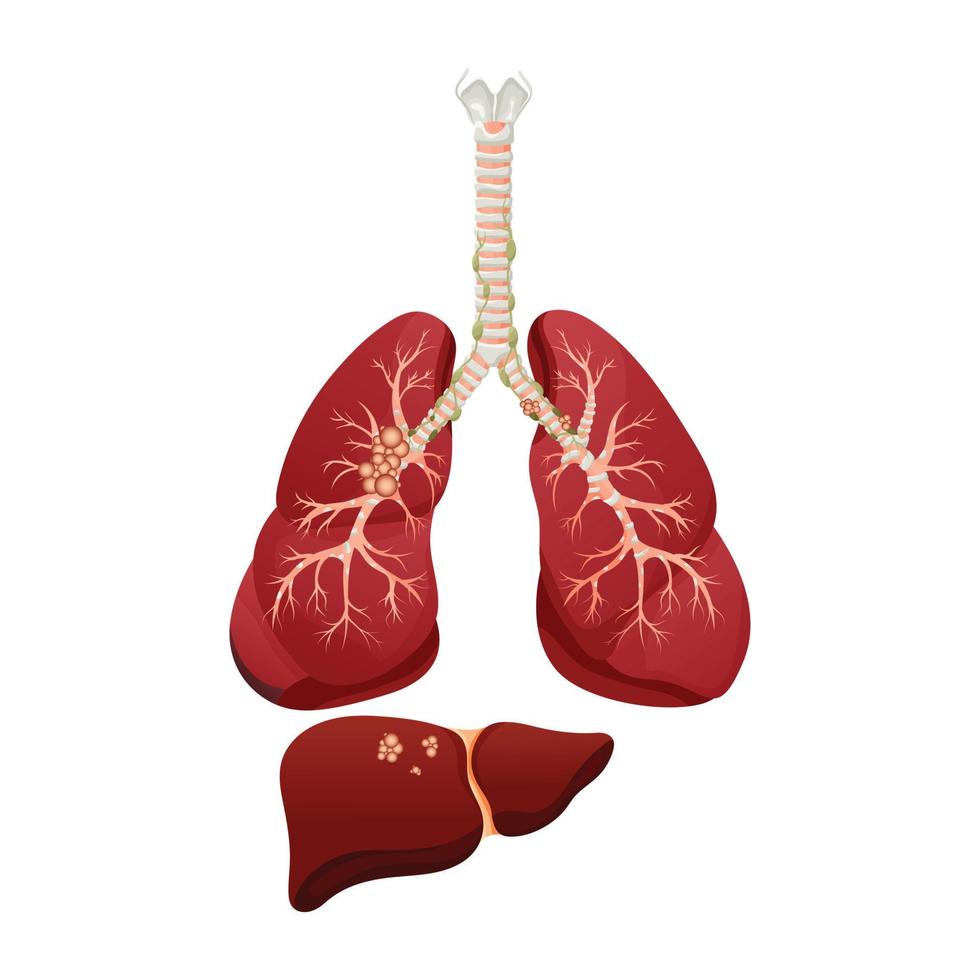 diagramma malattia del cancro del polmone. concetto di malattia degli organi interni umani. illustrazione vettoriale, stile cartone animato. vettore