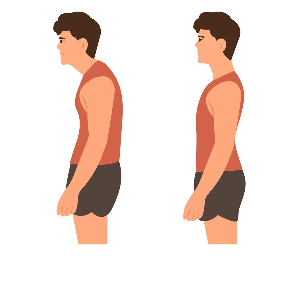 postura eretta corretta e scorretta.curvatura della colonna vertebrale cervicale. gobba. illustrazione sana di back.vector su sfondo bianco. vettore