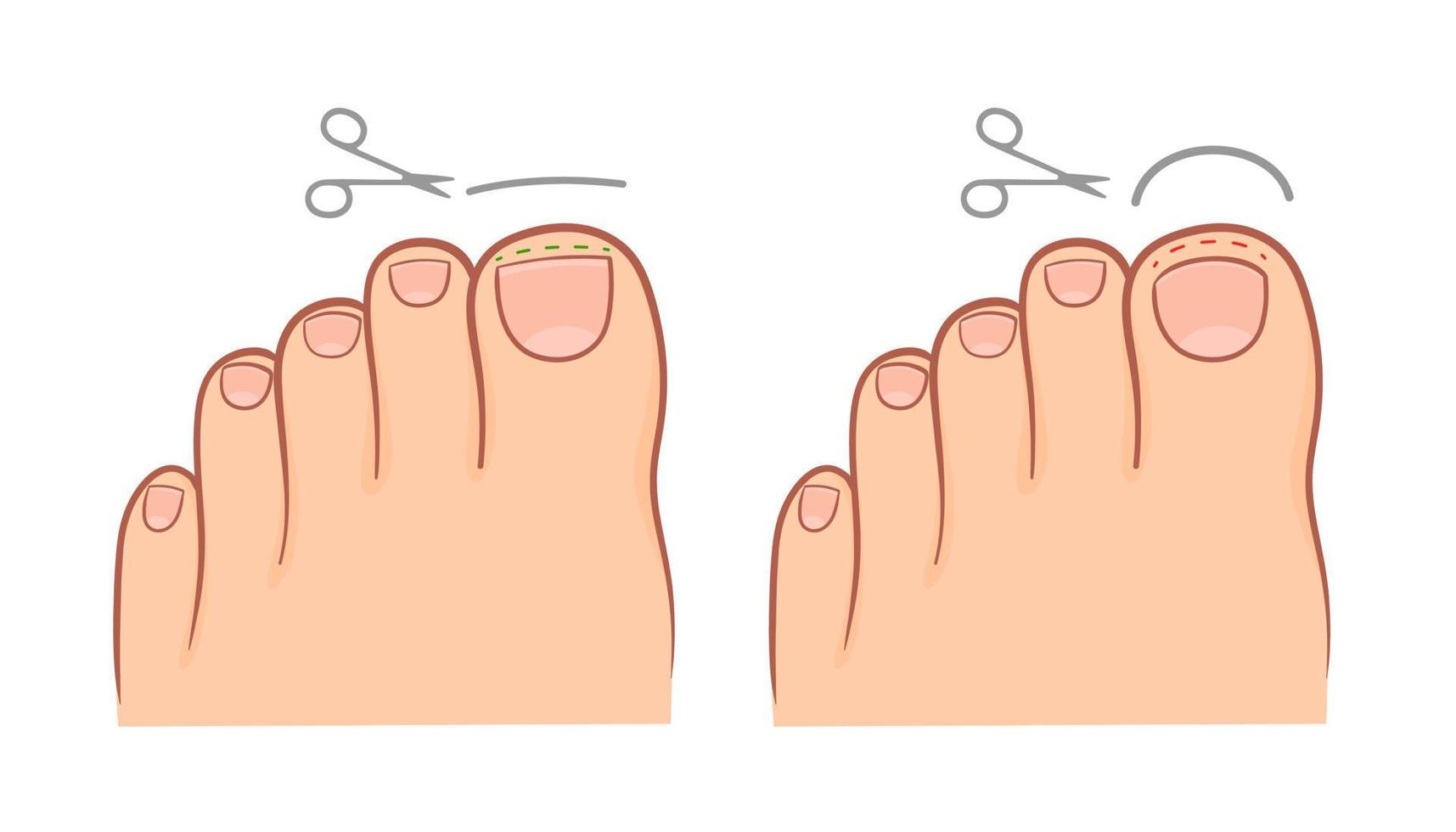 corretta e improprio taglio di il unghia del piede. medico illustrazione vettore