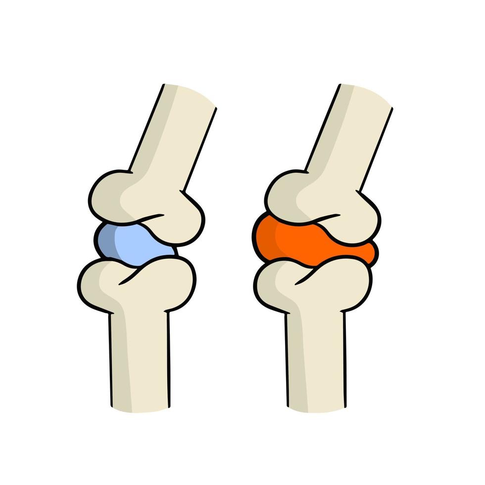 artrite. malattia di articolazioni. ossatura e interosseo cartilagine. biologia e anatomia. medico formazione scolastica e chirurgia. rosso dolorante macchiare. cartone animato illustrazione vettore