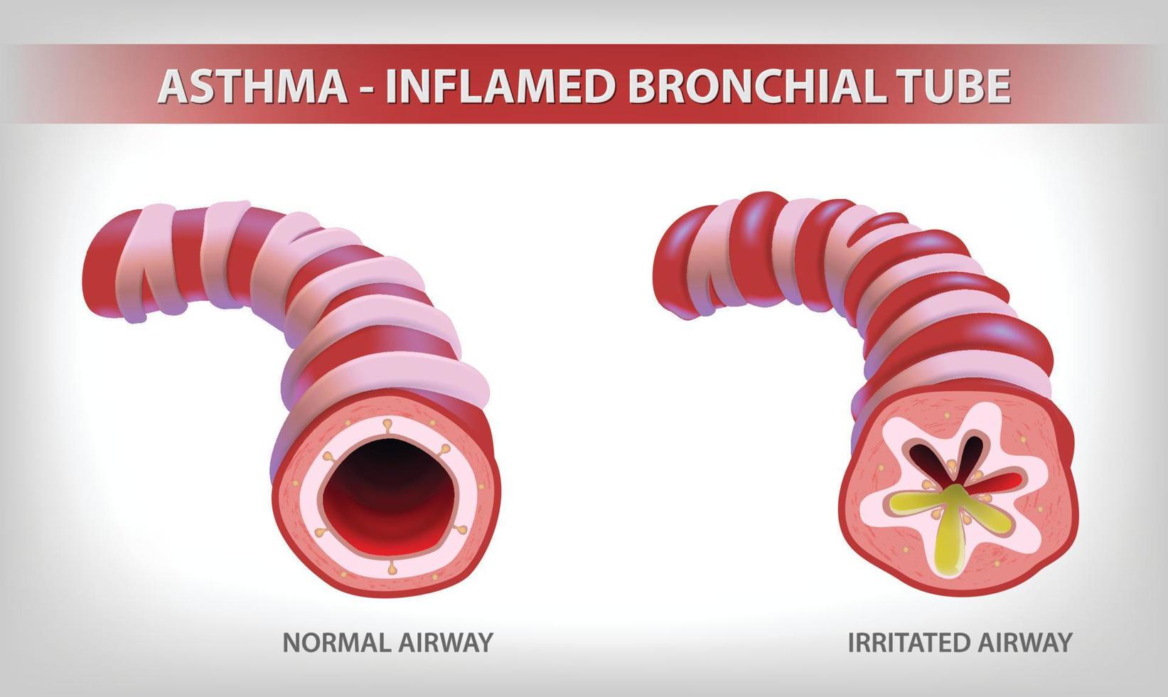 il illustrazione Spettacoli Due parti di il bronchi, uno normale e il altro bronchite e pieno con espettorato. vettore