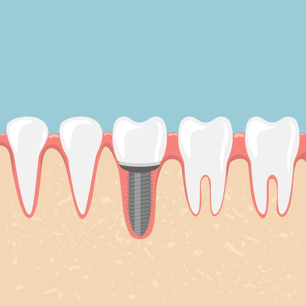 denti umani e impianto dentale vettore