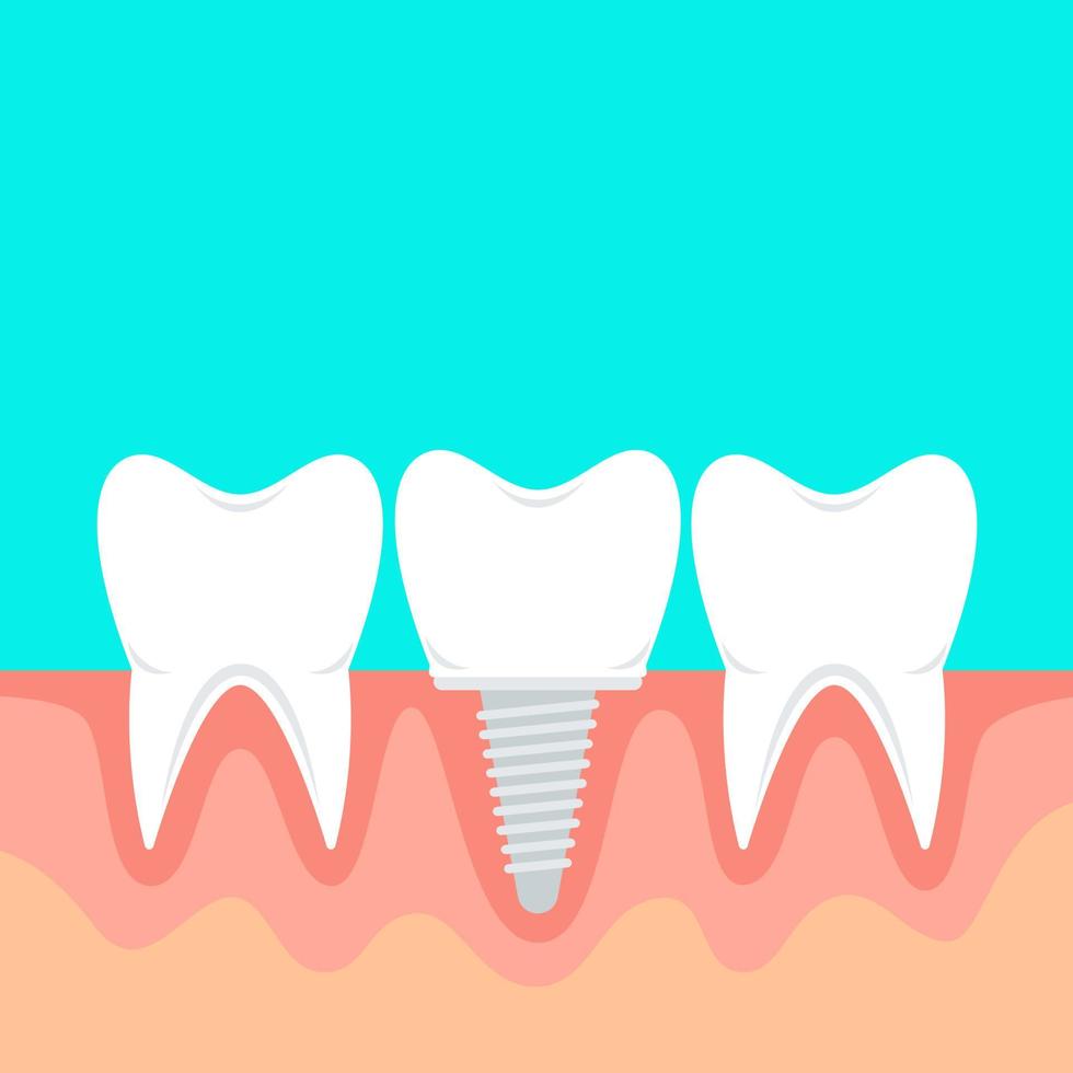 umano denti e dentale impiantare. vettore azione illustrazione nel piatto stile con copia spazio.
