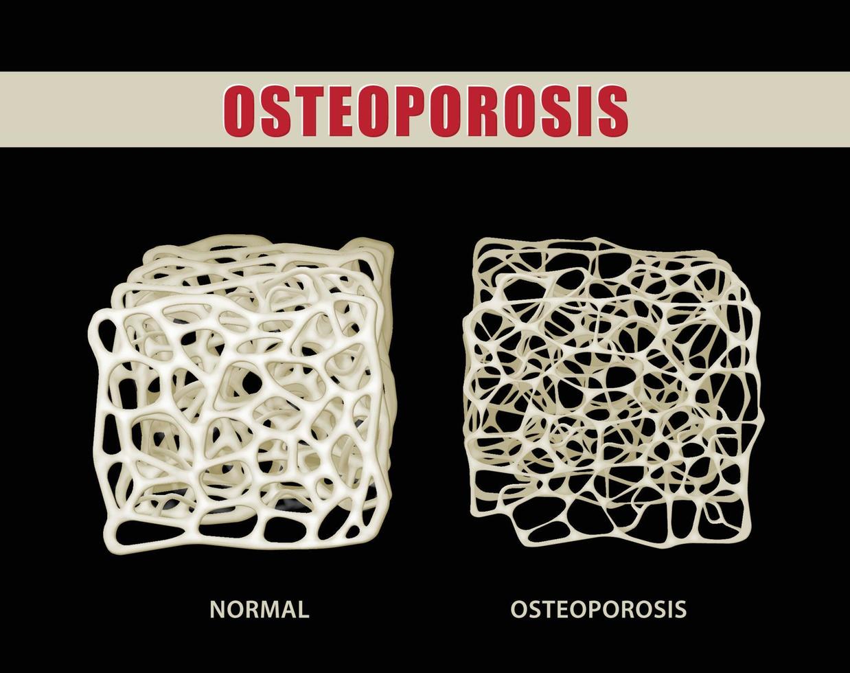 3d illustrazione confrontando osteoporosi con normale osso su nero sfondo. vettore