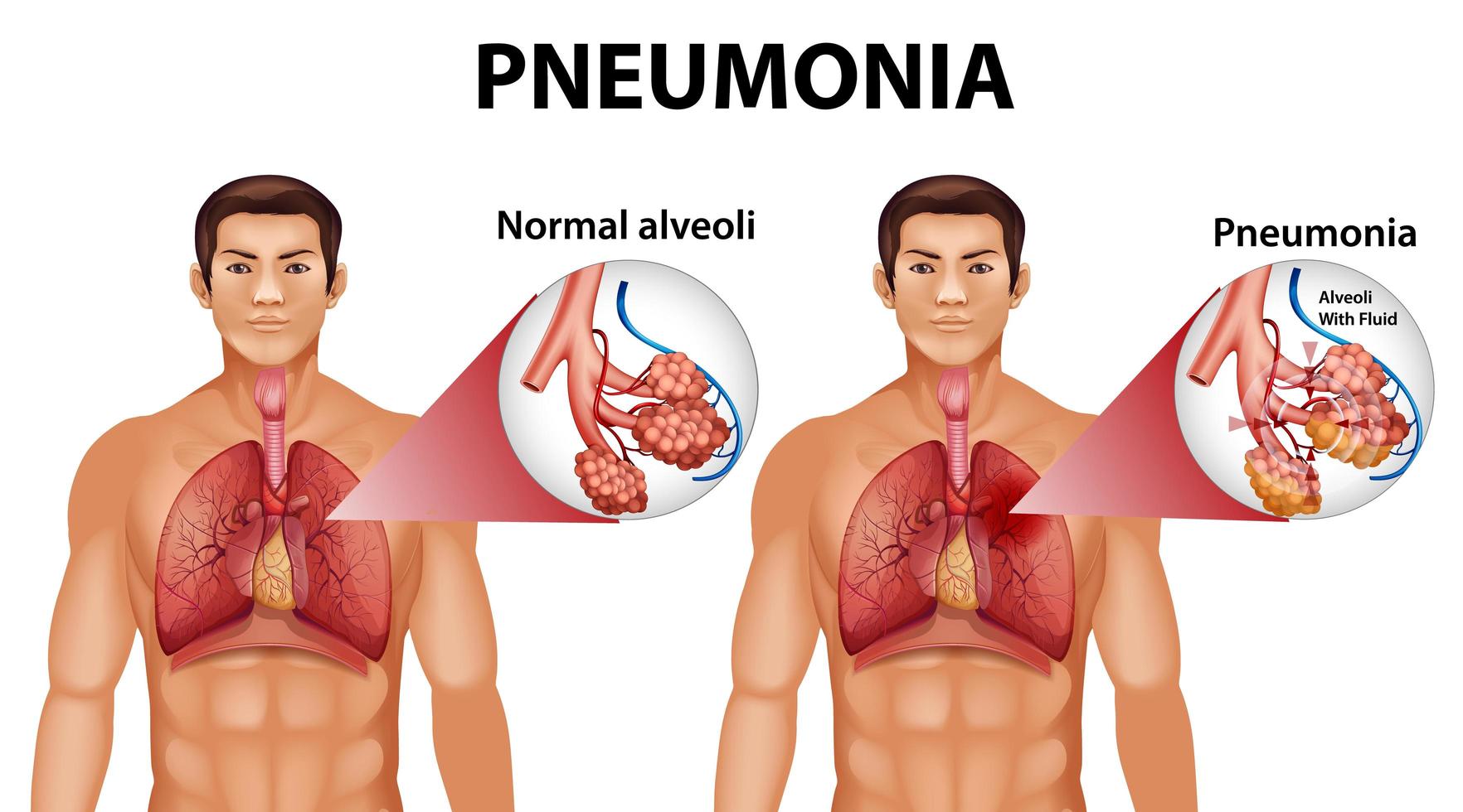 disegno educativo di anatomia umana della polmonite vettore