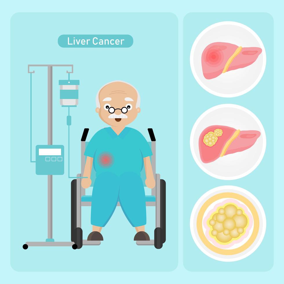uomo anziano con cancro al fegato vettore