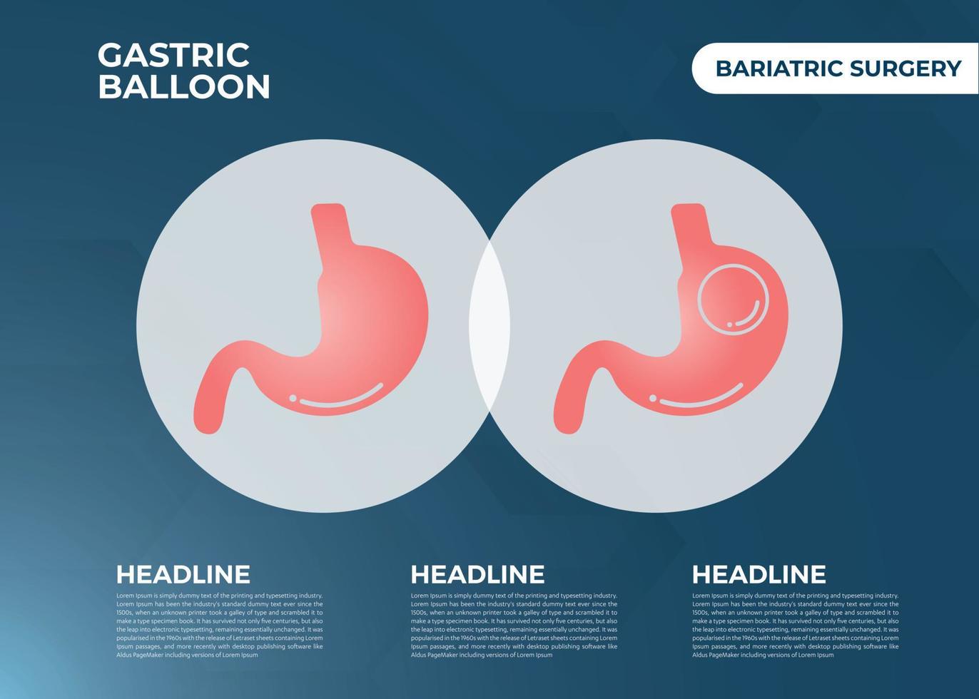 stomaco endoscopia gastrico Palloncino dentro un' stomaco peso perdita chirurgia vettore illustrazione obesità