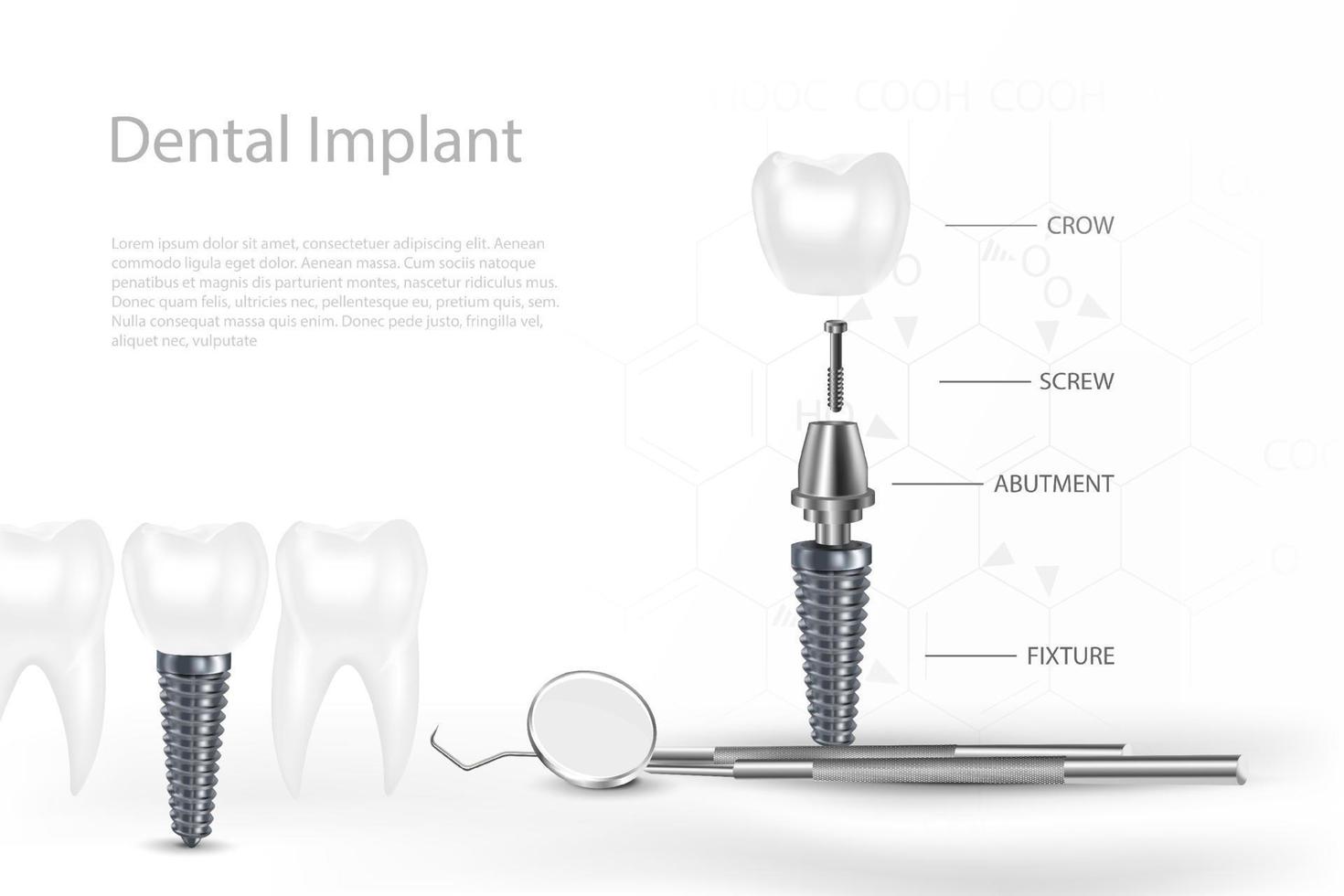 3d dentale impianti chirurgia concetto con attrezzo. vettore