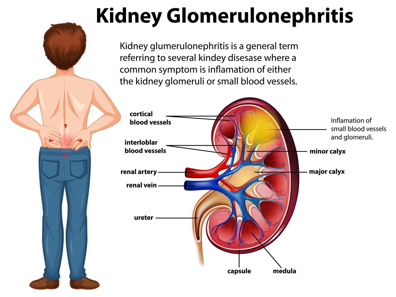 infografica medica del tema della glomerulosclerosi renale vettore