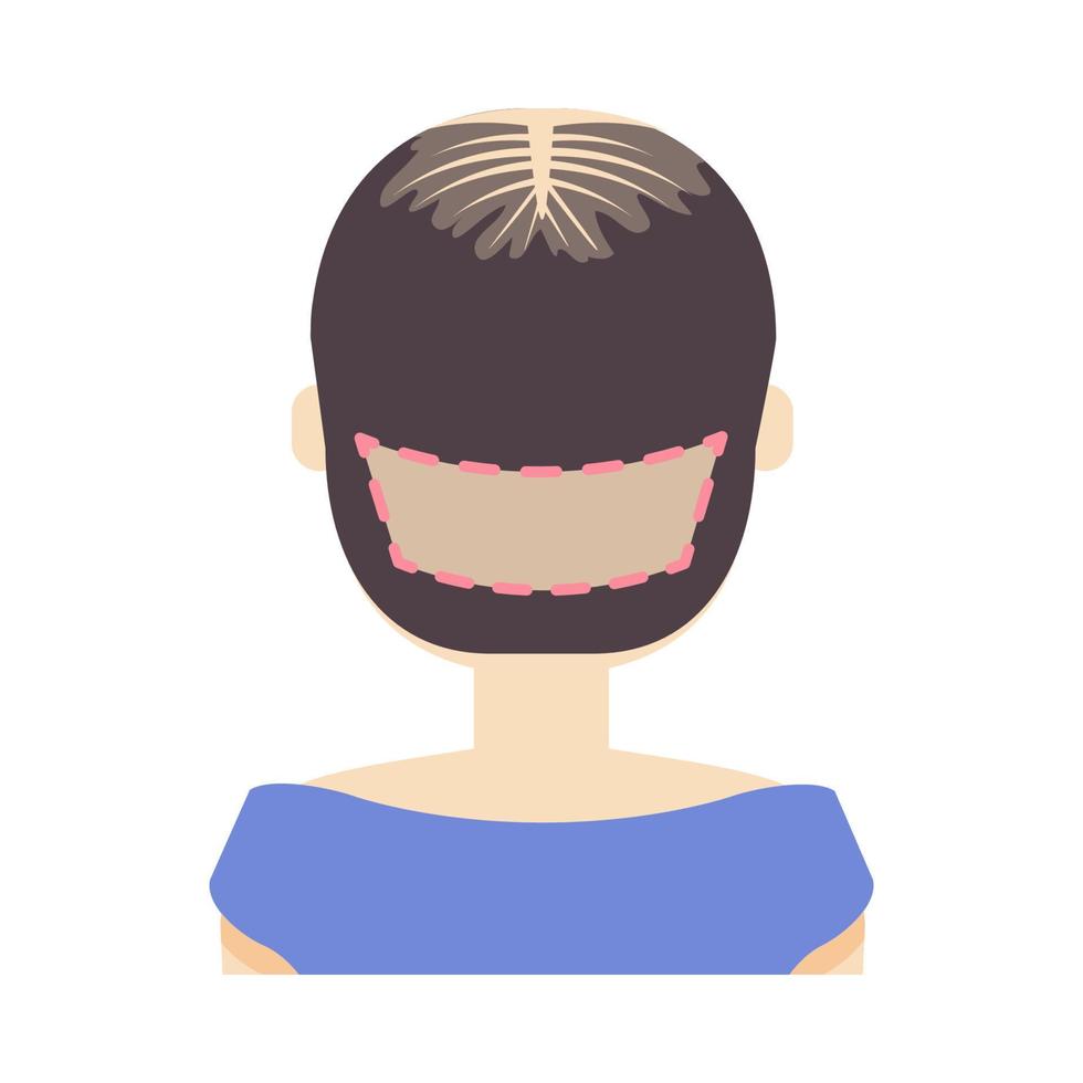 fue capelli trapianto trattamento di alopecia. indietro Visualizza di un' donna a chirurgia. femmina capelli perdita modello. medico infografica. cartone animato vettore illustrazione.