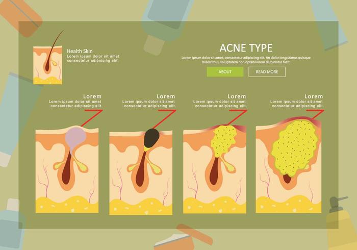 Illustrazione di tipo di acne gratis vettore