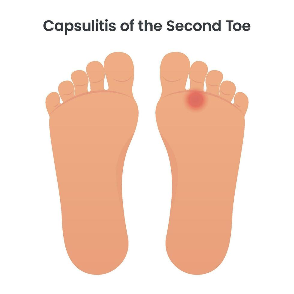 capsulite di il secondo dito del piede medico vettore illustrazione grafico
