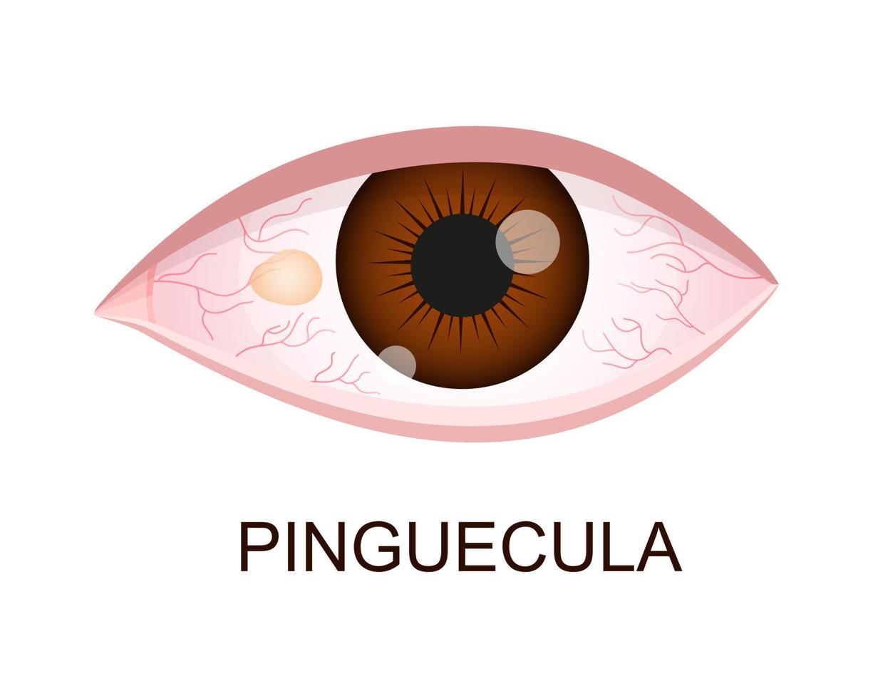 pinguecula. congiuntivale degenerazione. occhio patologia. umano organo di visione con patologia vettore