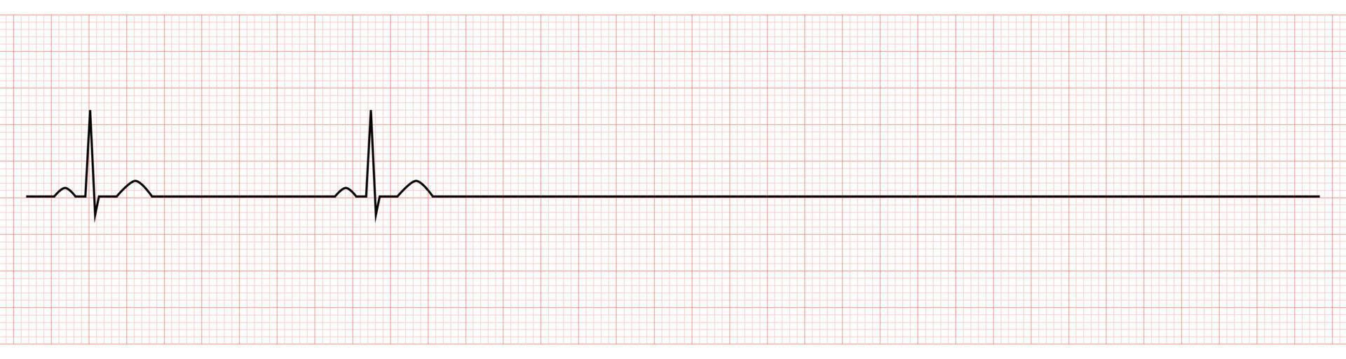 ekg mostrando seno bradicardia con arresto di paziente vettore