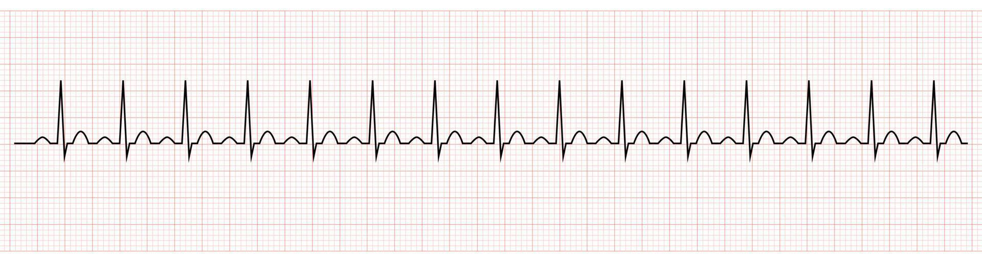 ekg mostrando seno tachicardia di paziente vettore