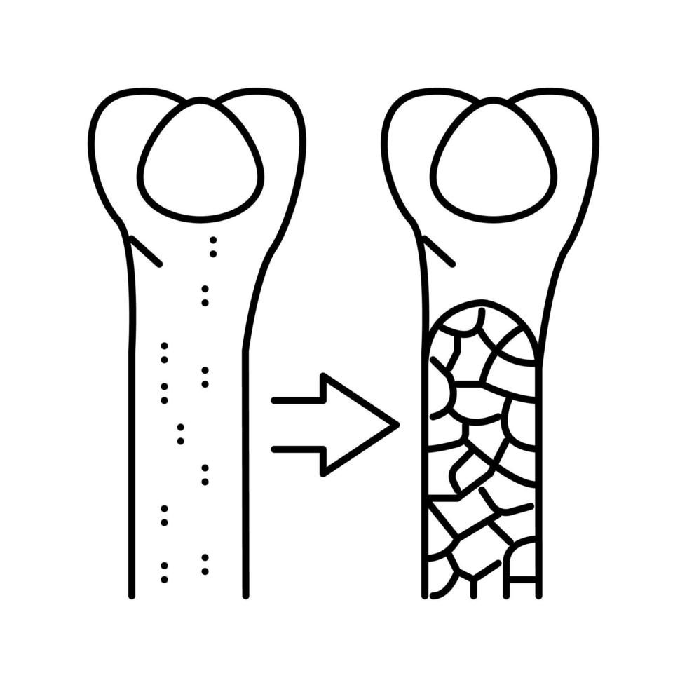 illustrazione vettoriale dell'icona della linea della malattia ossea dell'osteoporosi