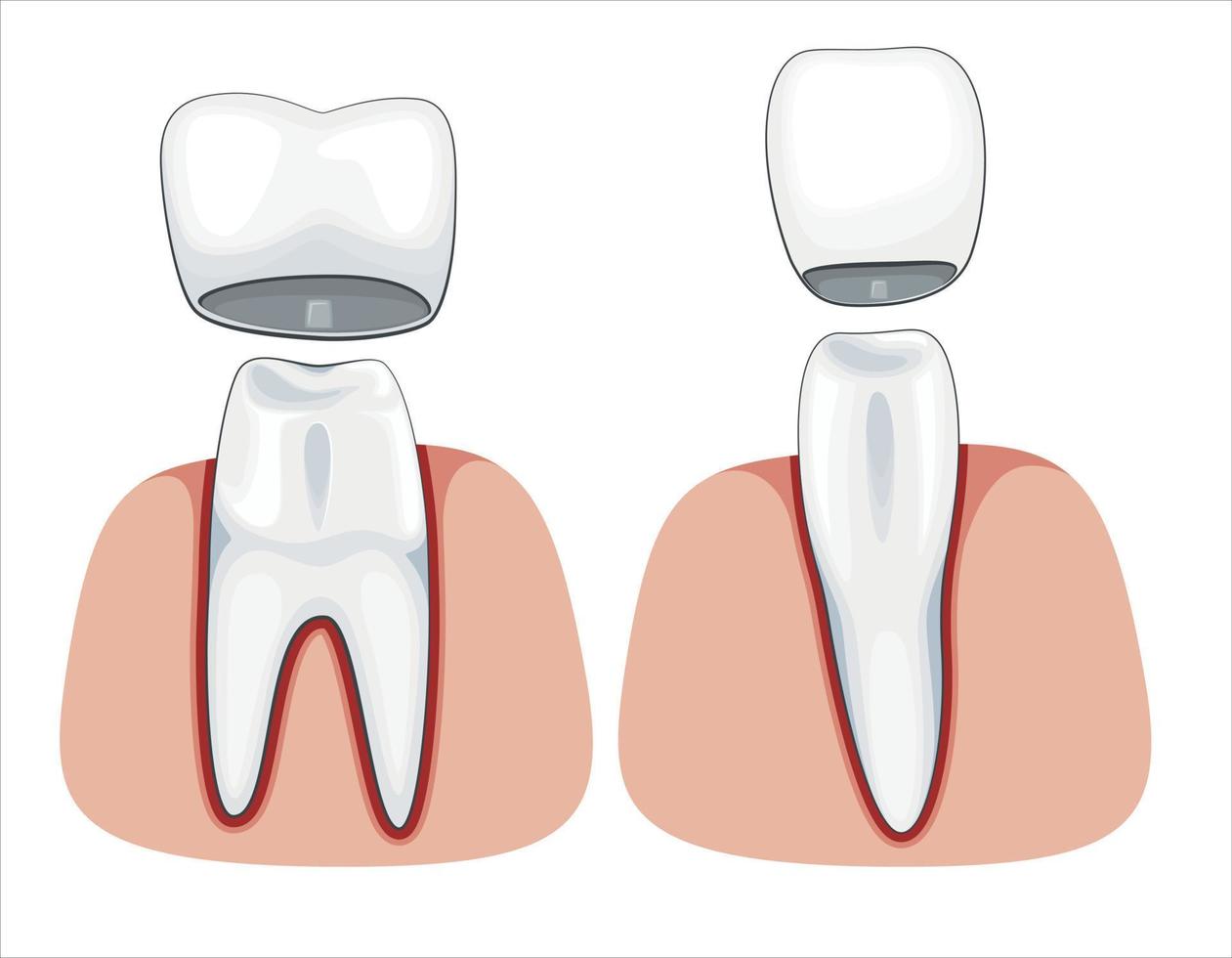 dente corona illustrazione, salutare denti, dentista vettore illustrazione, orale cura