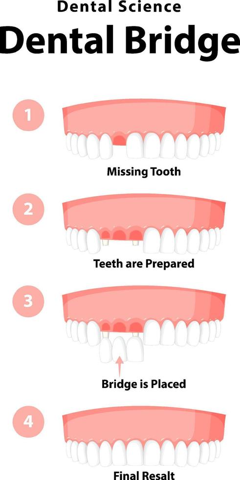 infografica dell'essere umano nel ponte dentale su sfondo bianco vettore