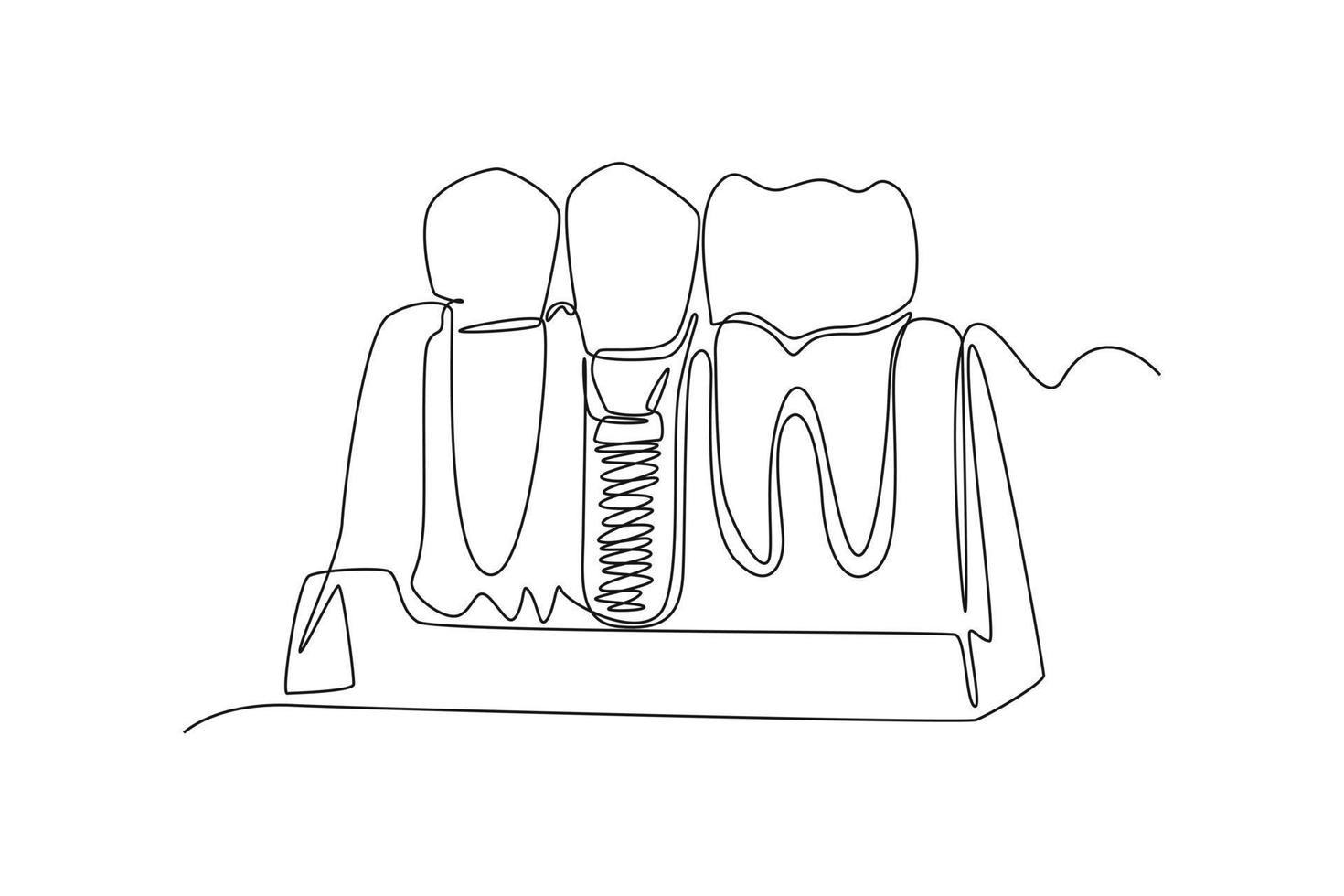 continuo uno linea disegno denti con dentale impiantare. dentale Salute concetto. singolo linea disegnare design vettore grafico illustrazione.