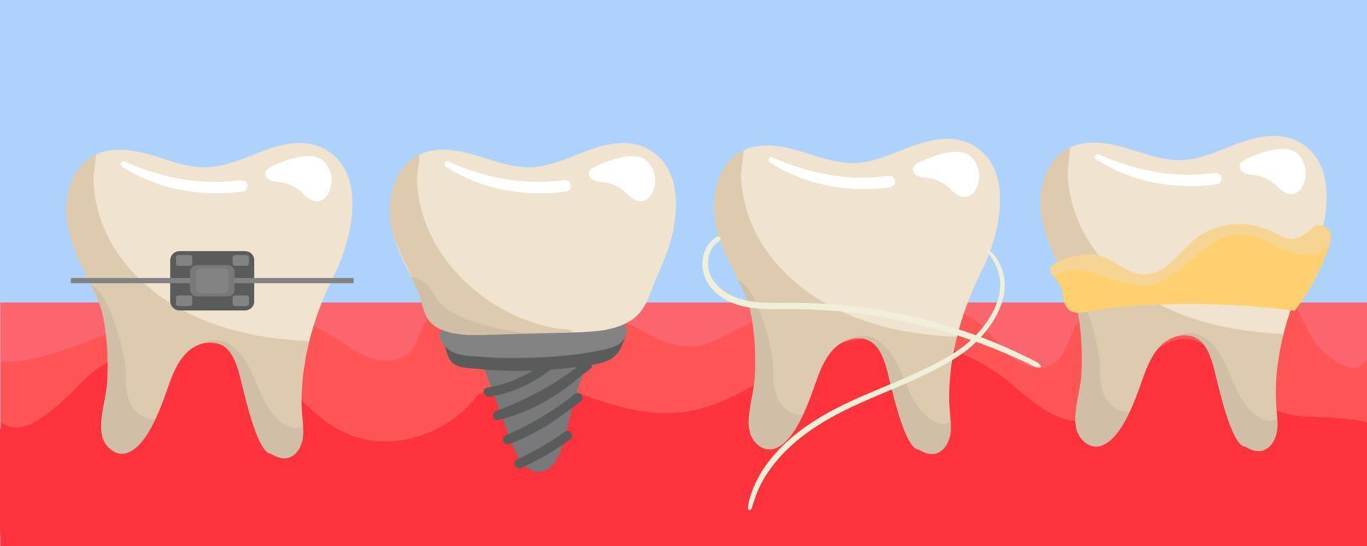 un' impostato di denti su il gengive con bretelle, un' falso dente, pulito con dentale filo interdentale, con tartaro e placca. il denti siamo diverso su il gengive. illustrazione nel un' piatto stile vettore