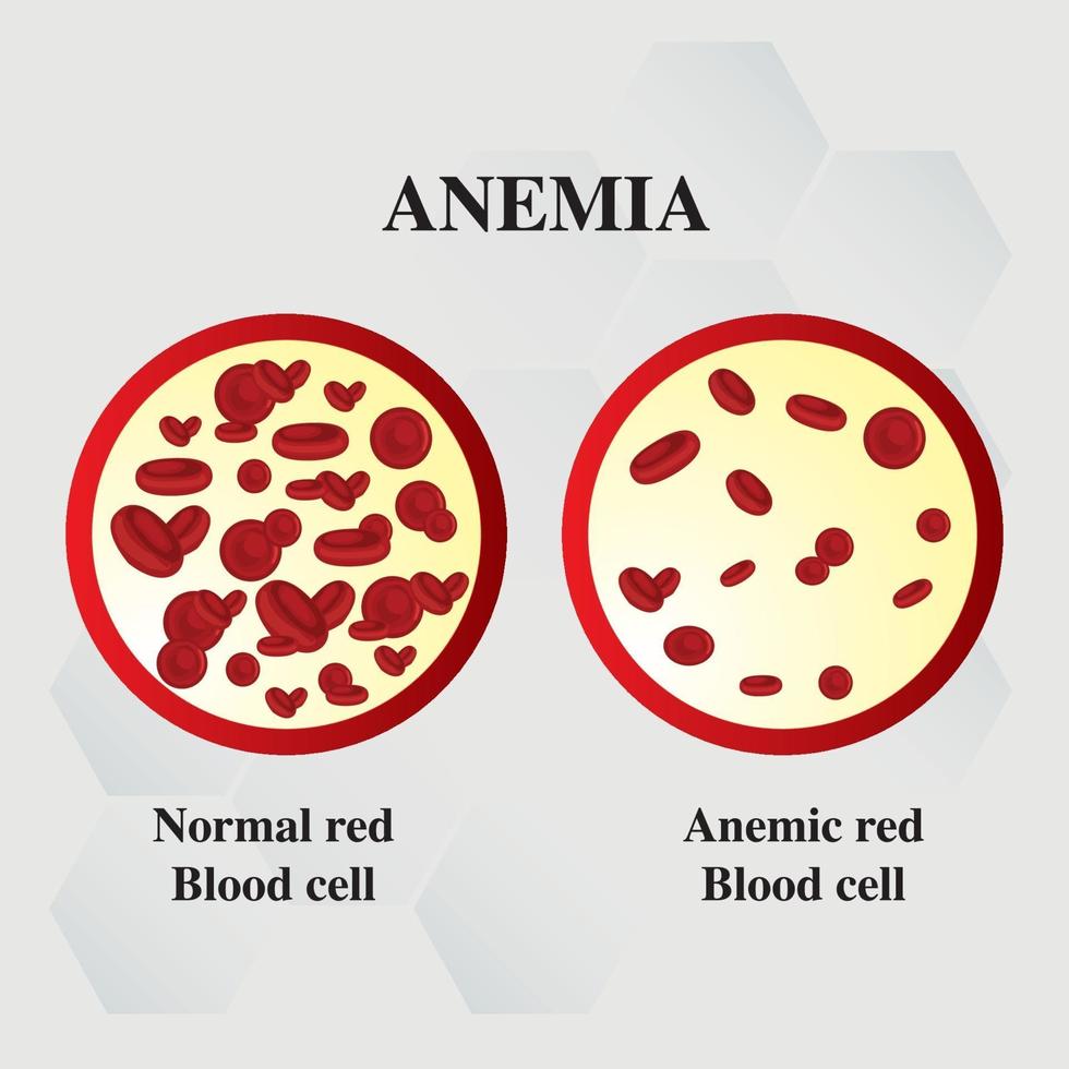 quantità di anemia di carenza di ferro nel sangue rosso differenza di anemia di quantità di anemia di globuli rossi e sintomi normali illustrazione vettoriale medica.