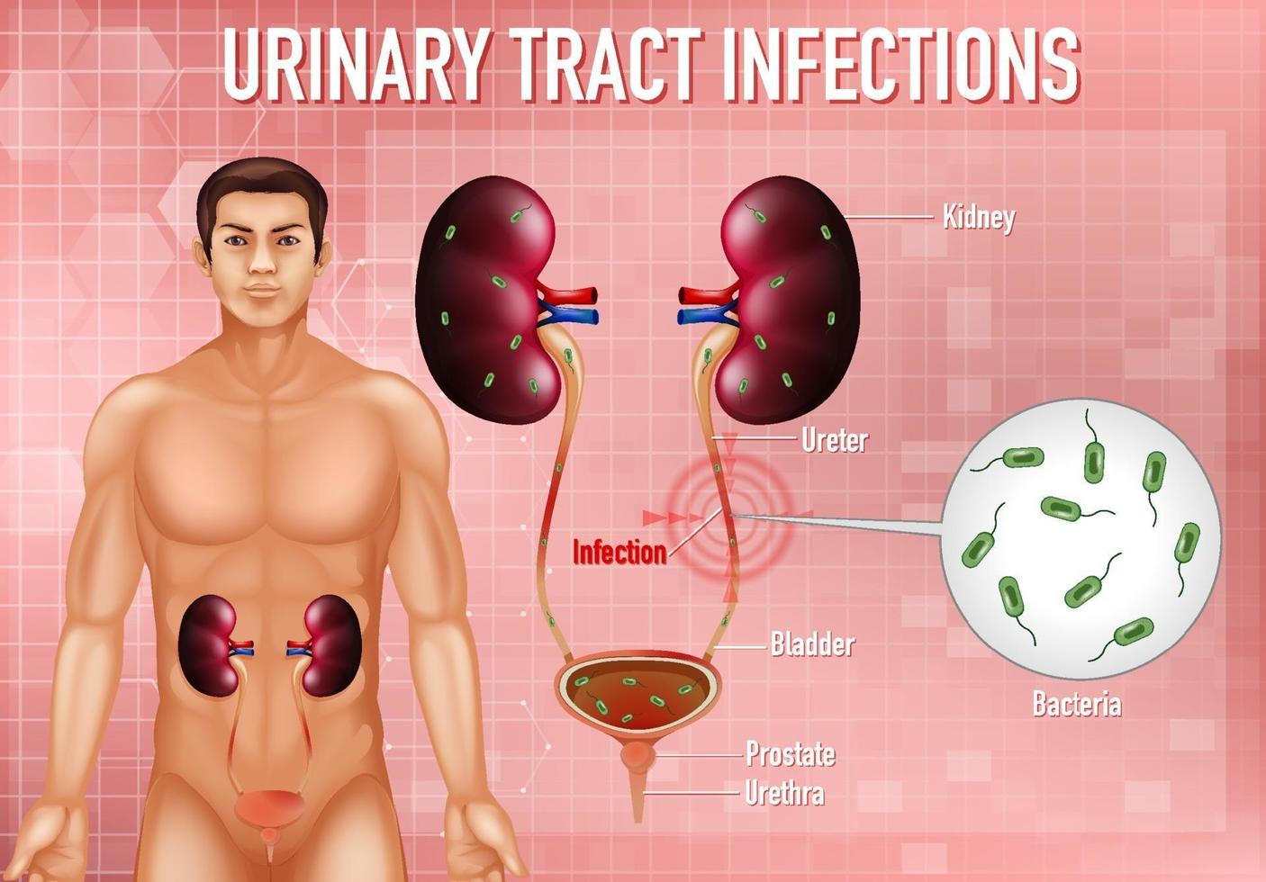 illustrazione informativa delle infezioni del tratto urinario vettore