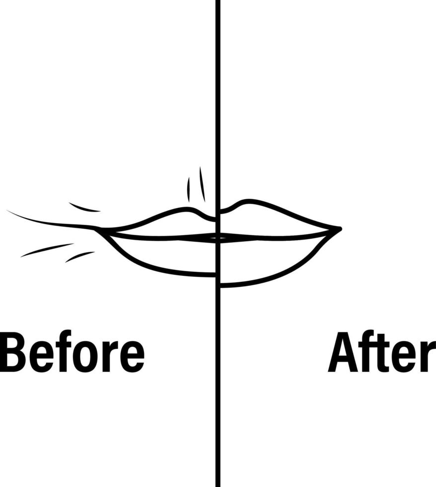 donna labbra prima e dopo trattamento. vettore