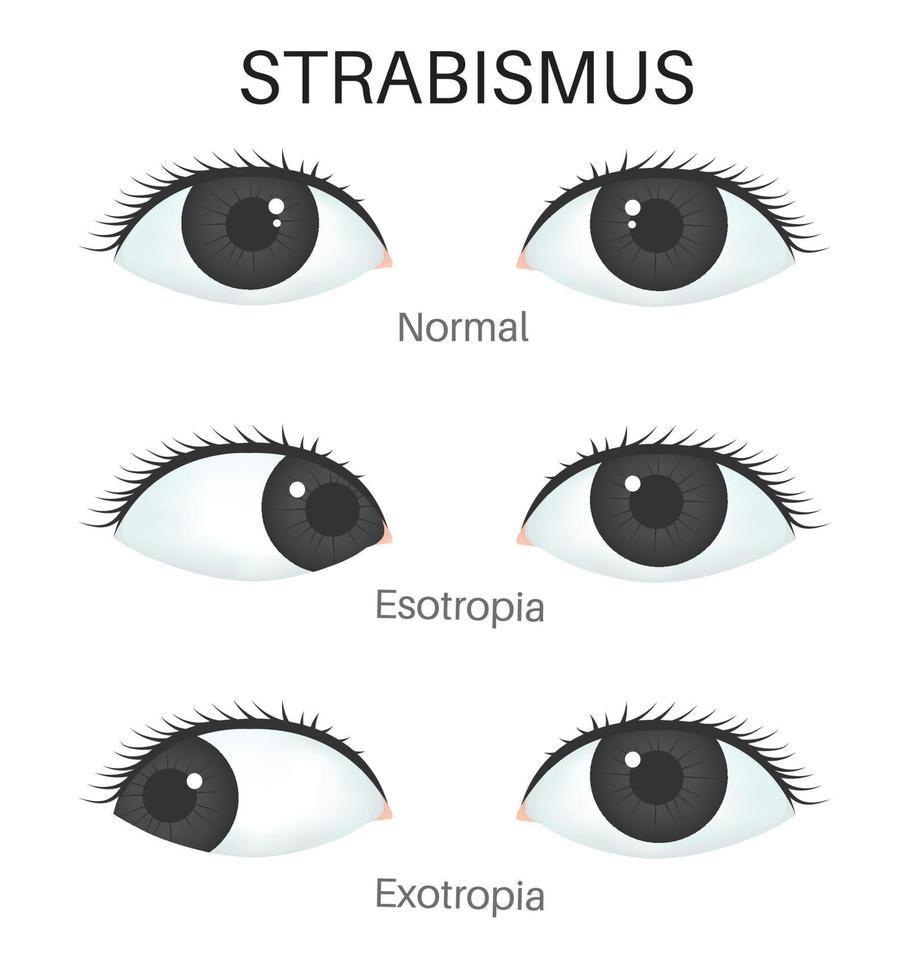 tipi di strabismo- esotropia e esotropia vettore