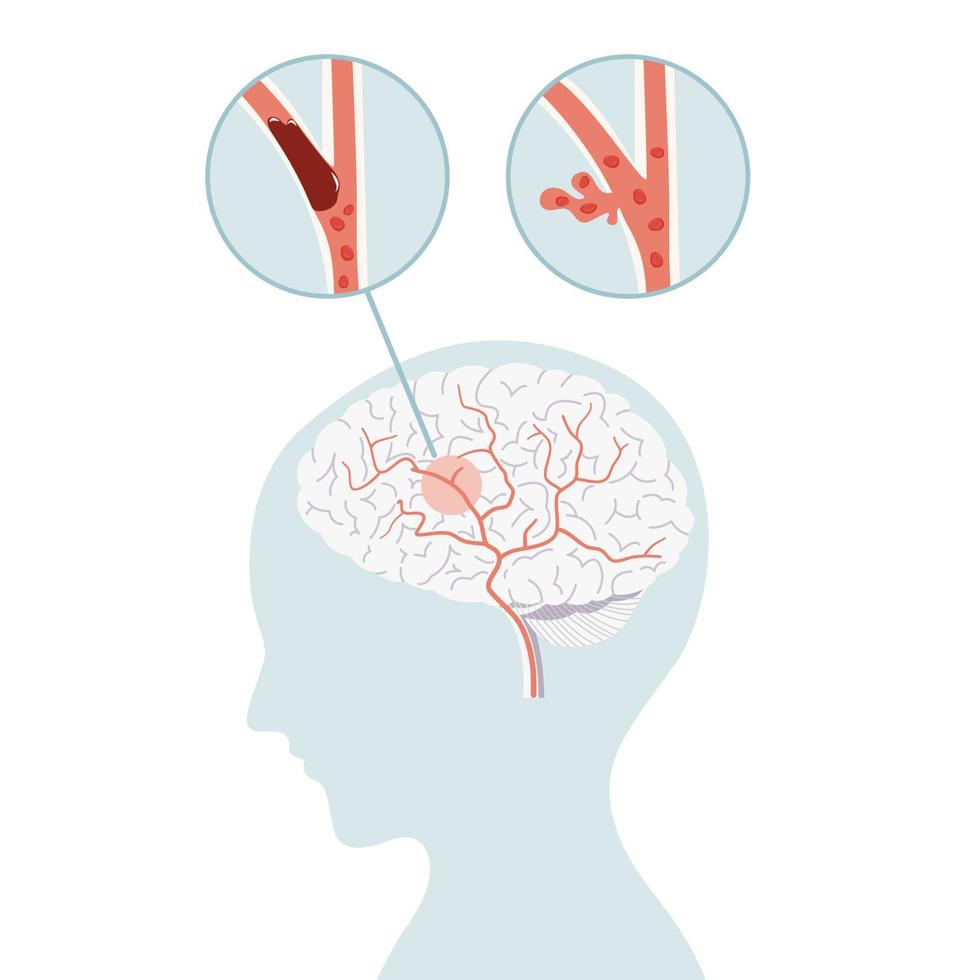 ischemico ictus e emorragico ictus, ictus cervello concetto nel piatto vettore. vettore