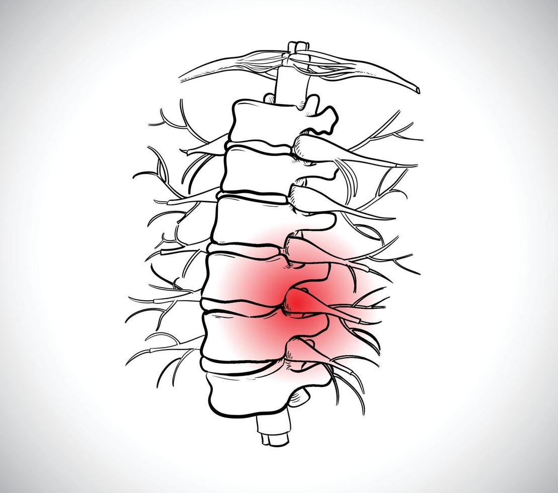 l'immagine dell'ernia del disco, può causare un forte dolore alla schiena che può portare alla paralisi vettore