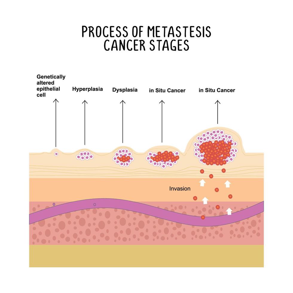 processi di metastasi cancro stadi illustrazione su bianca sfondo. vettore