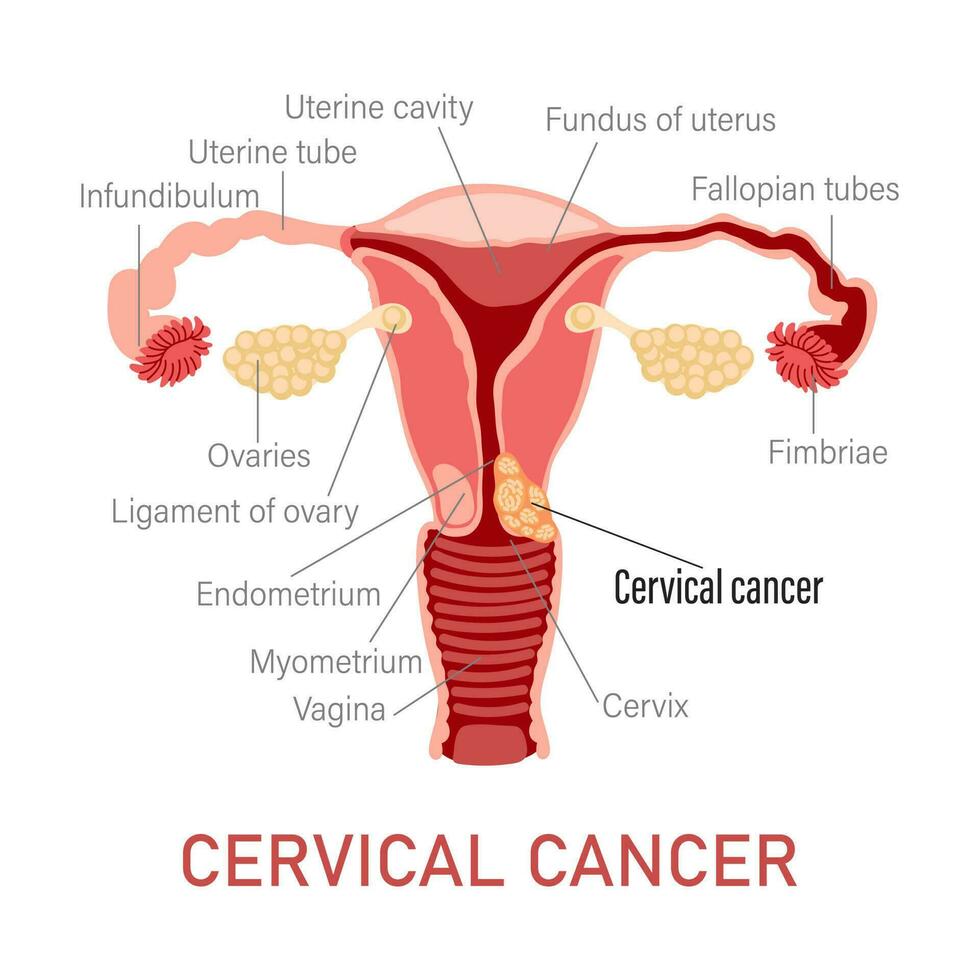 cervicale cancro. malattie di il femmina riproduttore sistema. ginecologia. medico concetto. Infografica striscione. vettore