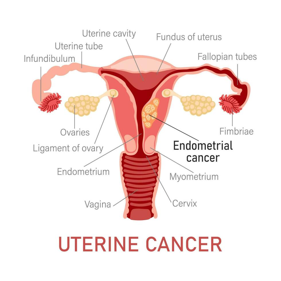 uterino cancro. malattie di il femmina riproduttore sistema. ginecologia. medico concetto. Infografica striscione. vettore