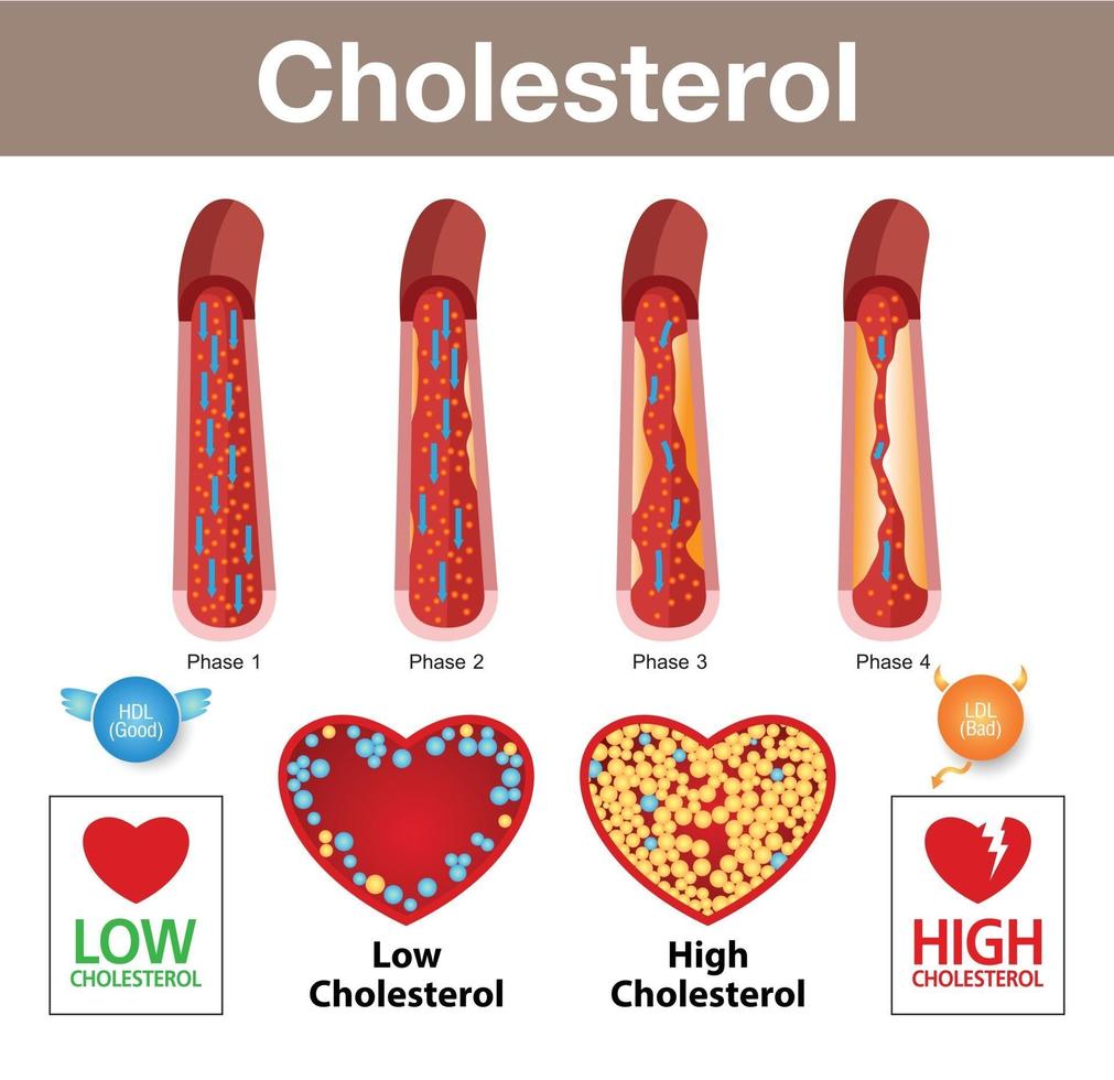 colesterolo nelle arterie e rischio per la salute vettore