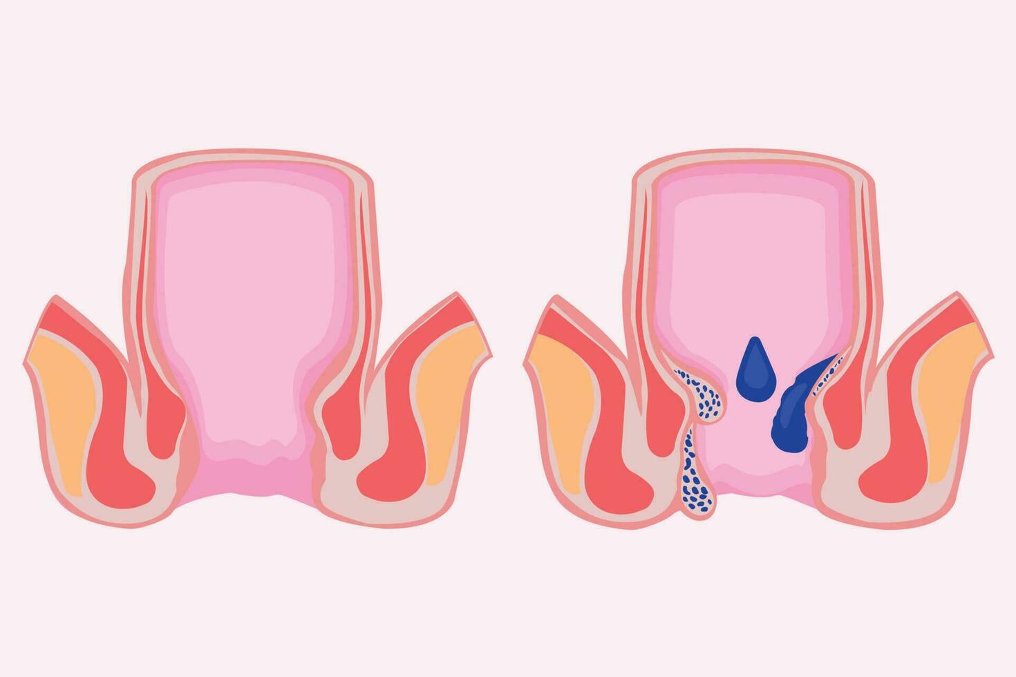 pile. emorroidale patologia. confronto e differenze fra salutare retto e parte di un' grande intestino con interno e esterno emorroidi, pettinare linea e rettale emorragia vettore