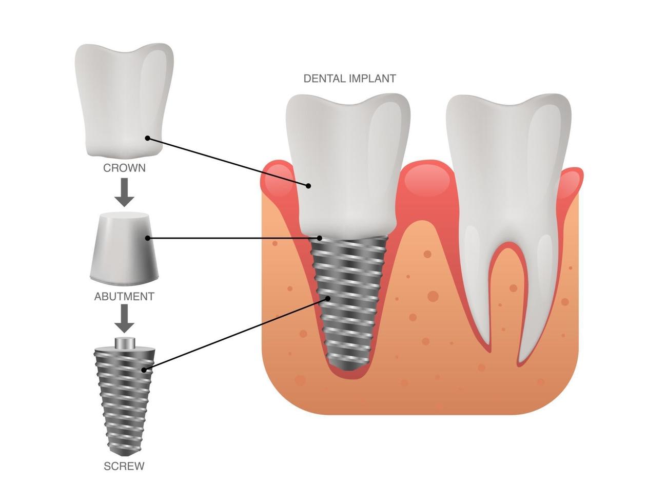 struttura dell'impianto dentale denti umani e illustrazione vettoriale impianto dentale